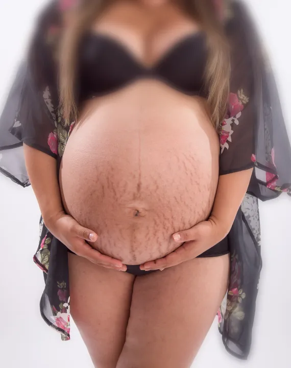 Pregnancy Marks Removal Pregnancy Marks Removal