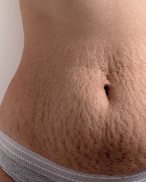 Pregnancy Stretch Mark Reduce Treatment