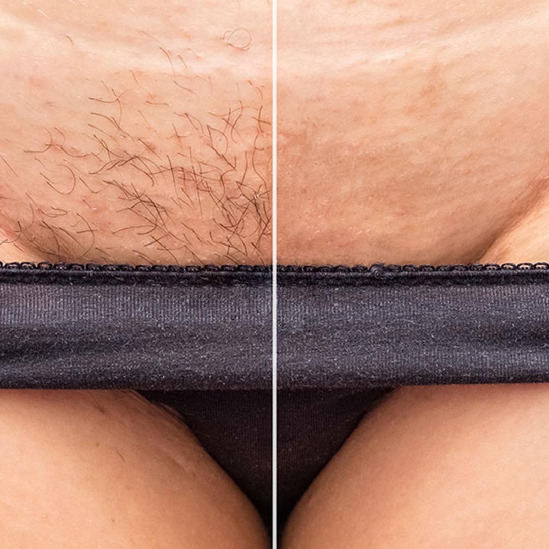 Vaginal Spot Remove Treatment