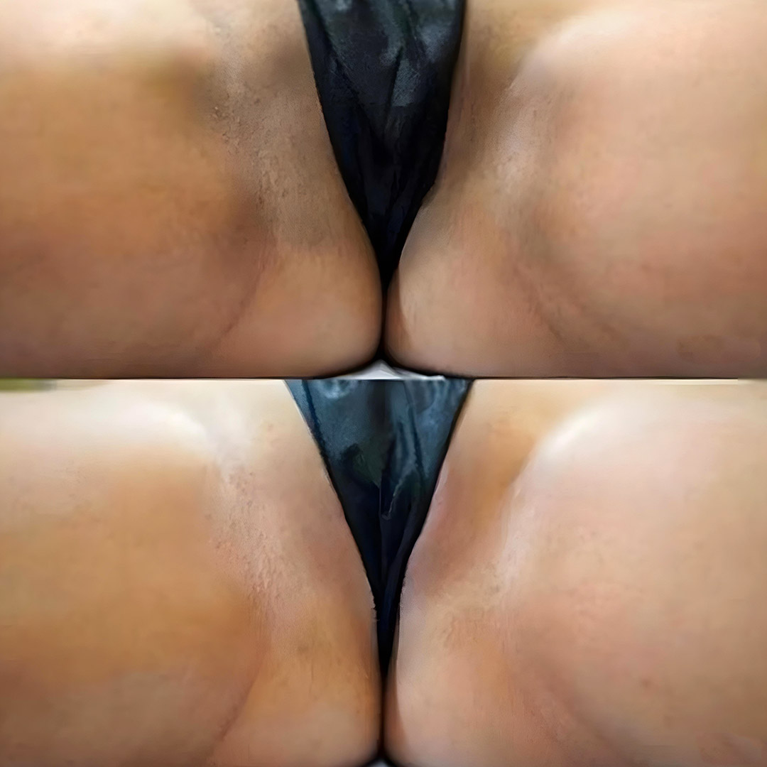 Vaginal Spot Remove Treatment