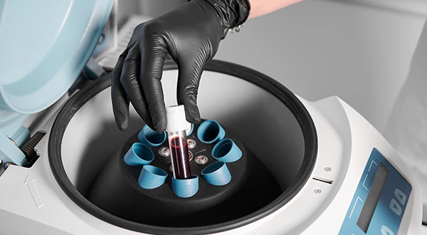 Advanced PRP Extraction At Dhanmondi Skin and Laser Center Advanced PRP Extraction At Dhanmondi Skin and Laser Center
