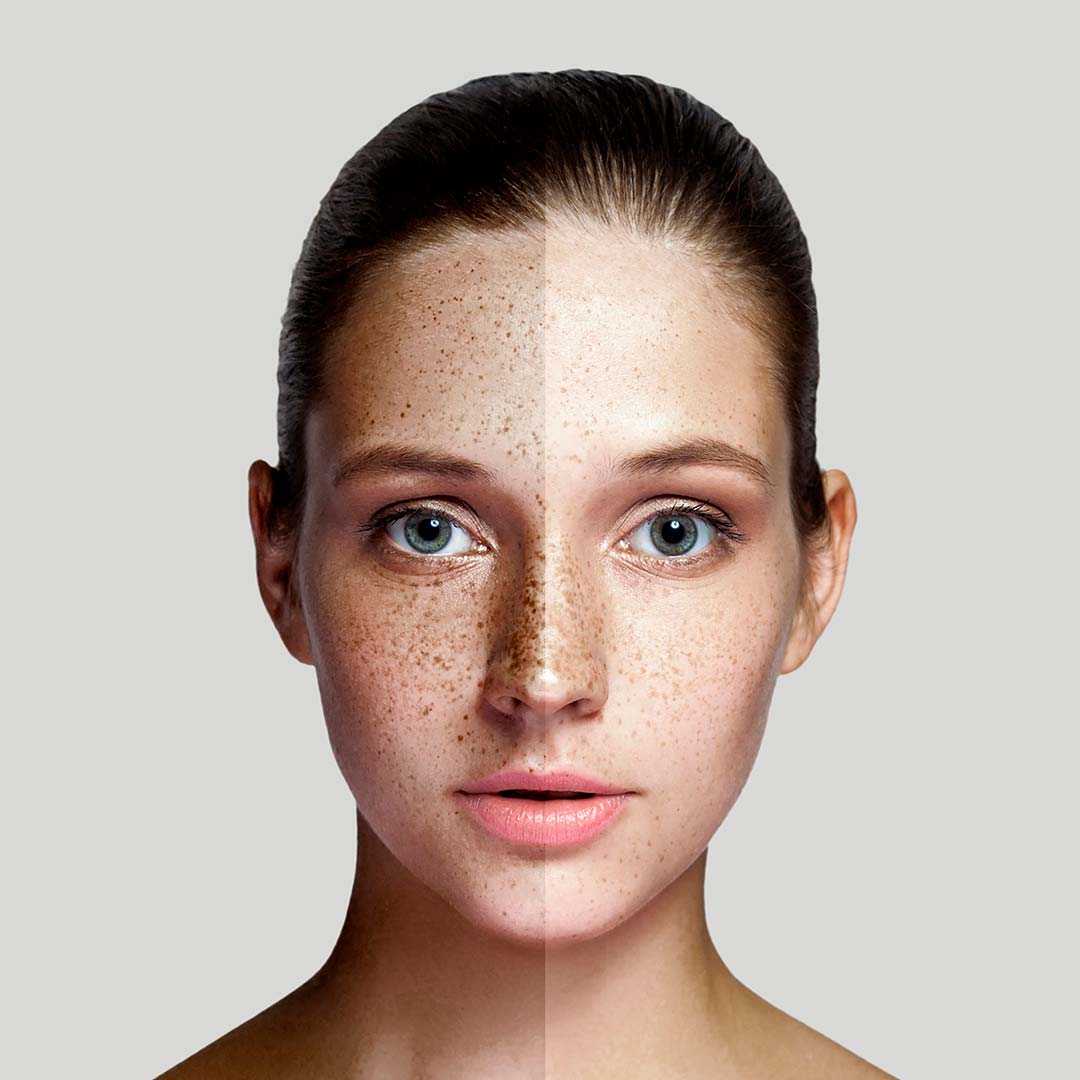 BB Glow Mesotherapy Before And After