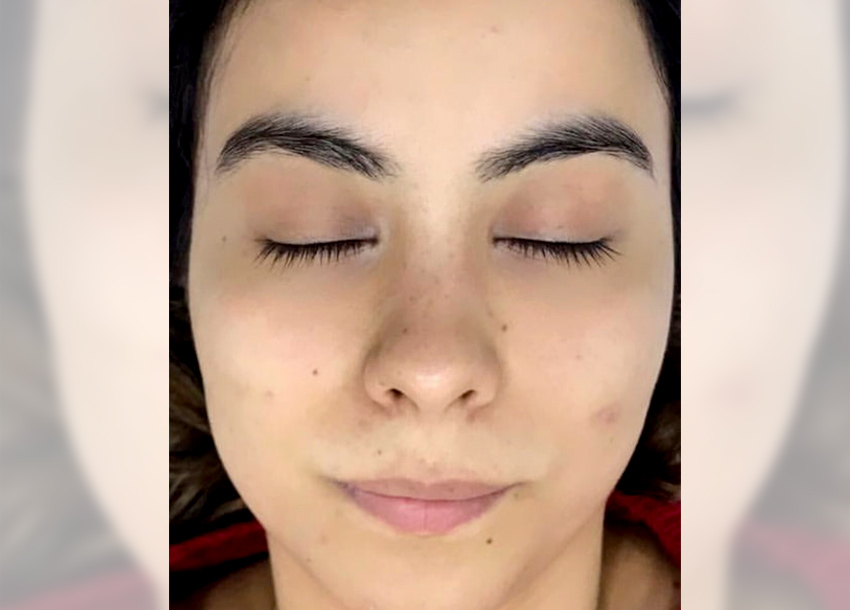 BB Glow Facial Before And After