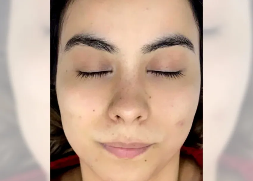 BB Glow Facial Before And After