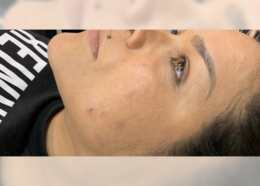 BB Glow Facial Before And After