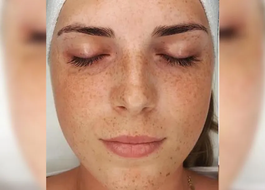 BB Glow Facial Before And After