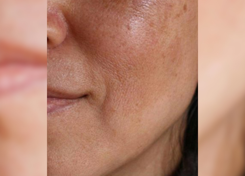 BB Glow Facial Before And After