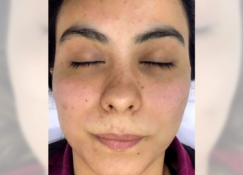 BB Glow Facial Before And After