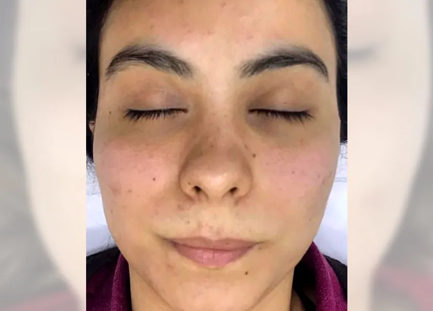 BB Glow Facial Before And After