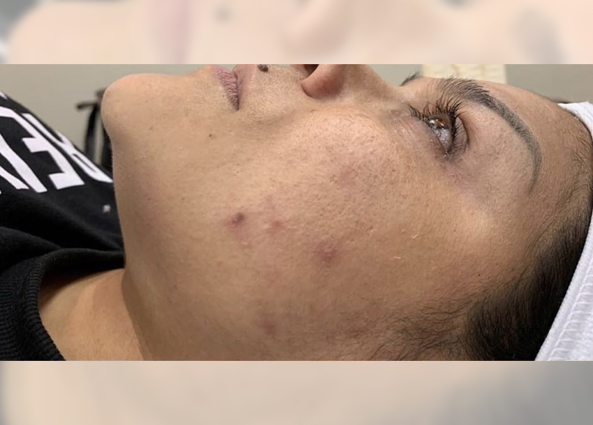 BB Glow Facial Before And After