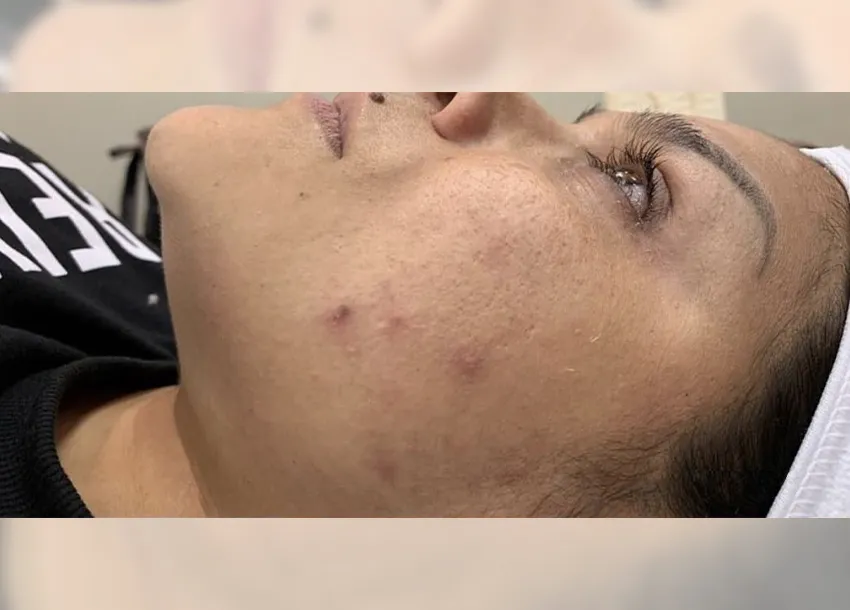 BB Glow Facial Before And After