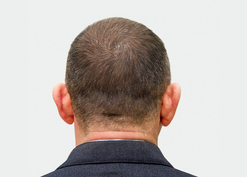 GFC Hair Growth Treatment Men