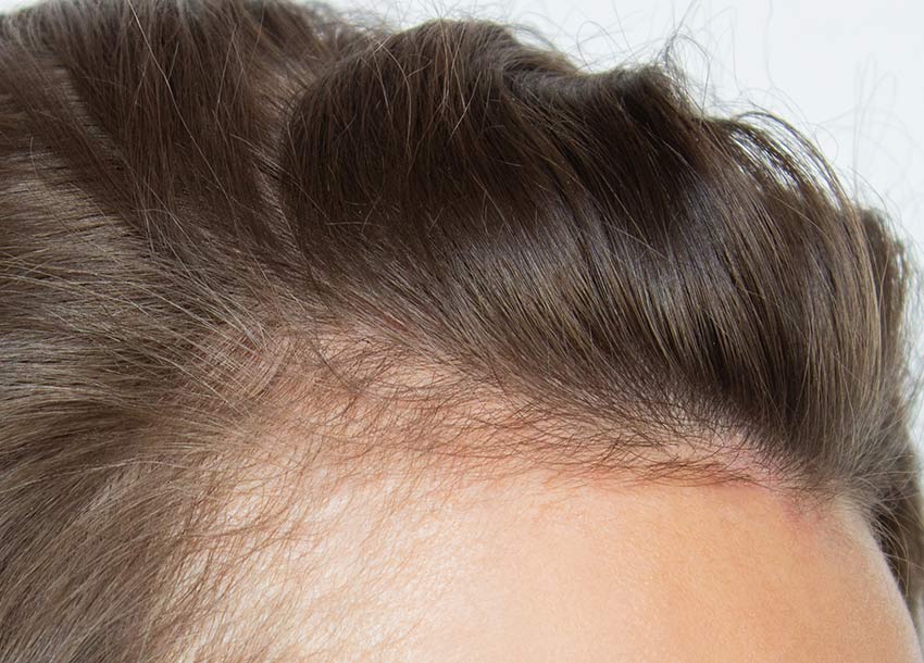 Collagen Hair Therapy for Men