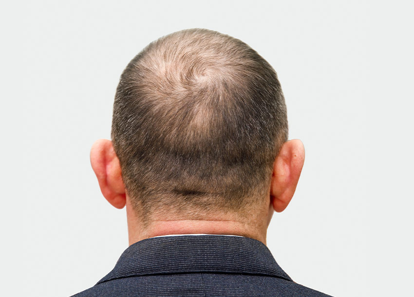GFC Hair Growth Treatment Men