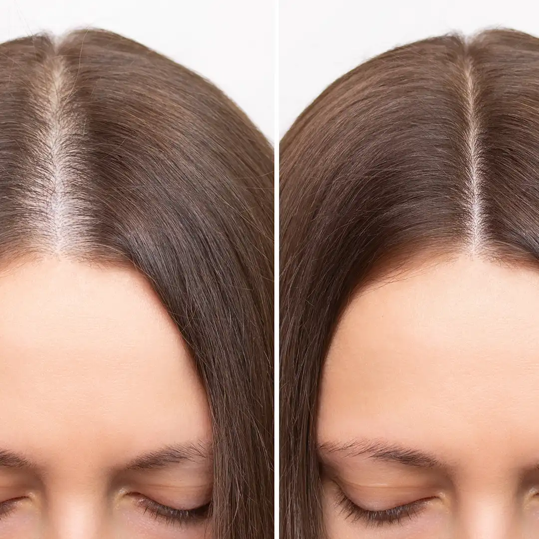 Hair PRP Treatment Service in Dhaka