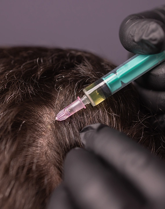 Hair PRP Treatment Dhanmondi Skin and Laser Center Hair PRP Treatment Dhanmondi Skin and Laser Center