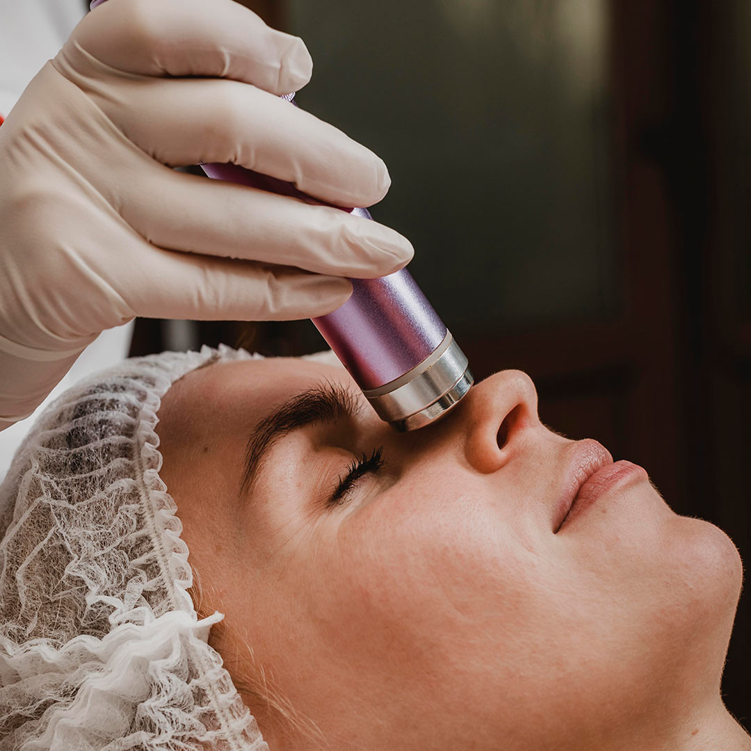 PRP with Microneedling