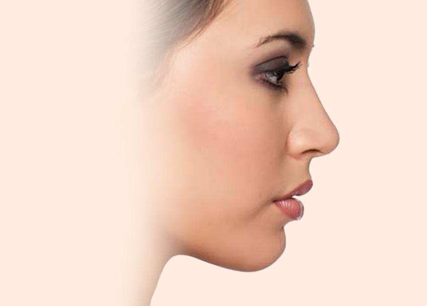 After PRP facial treatment with Microneedling