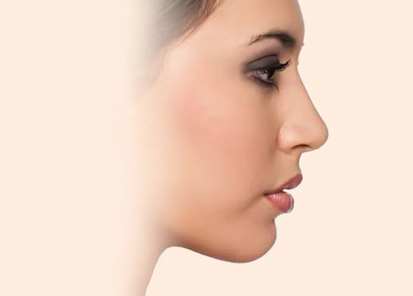 After PRP facial treatment with Microneedling