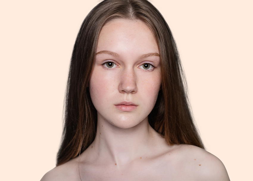 After PRP facial treatment with Microneedling
