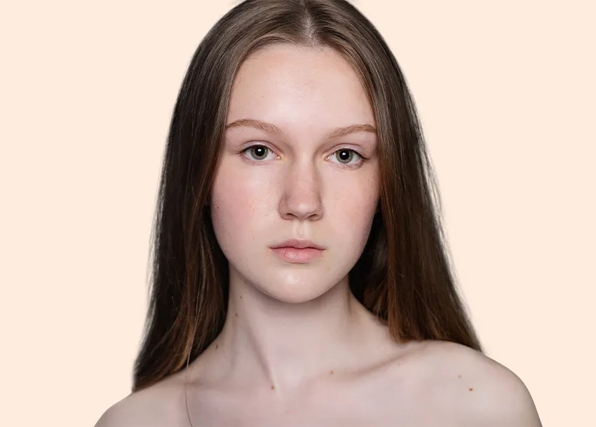 After PRP facial treatment with Microneedling