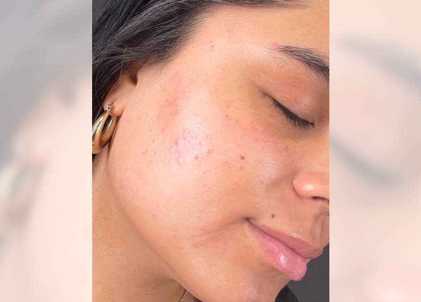 After PRP facial treatment with Microneedling