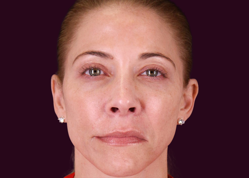 After PRP facial treatment with Microneedling