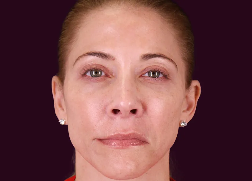 After PRP facial treatment with Microneedling