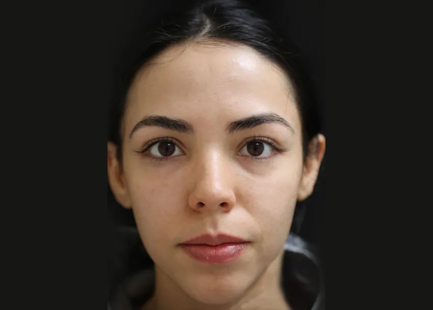 After PRP facial treatment with Microneedling