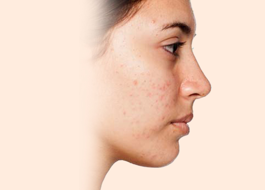Before PRP facial treatment with Microneedling