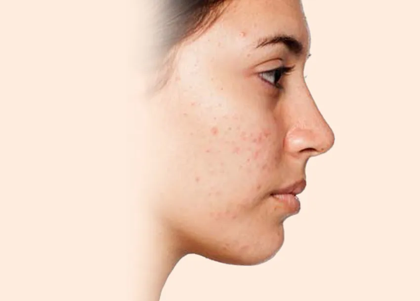 Before PRP facial treatment with Microneedling