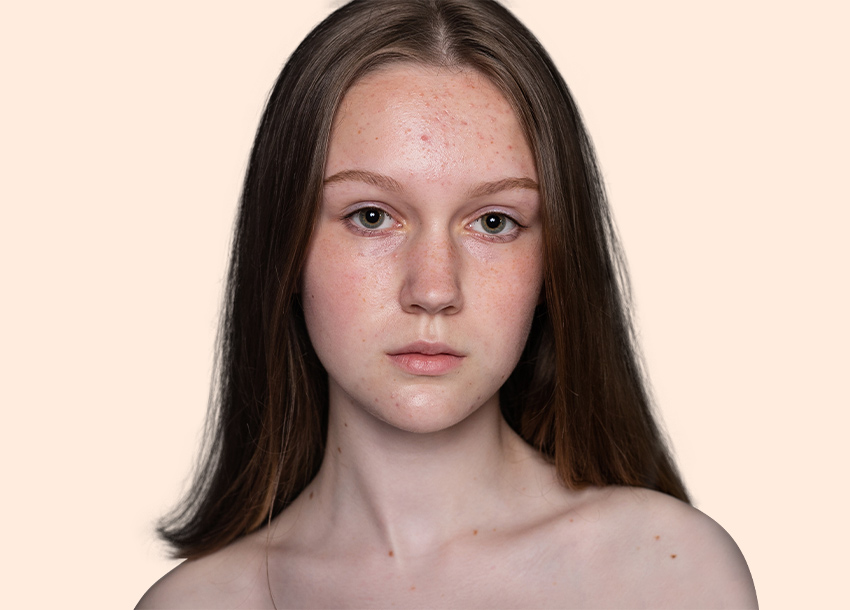 Before PRP facial treatment with Microneedling