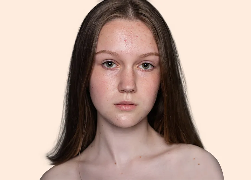 Before PRP facial treatment with Microneedling