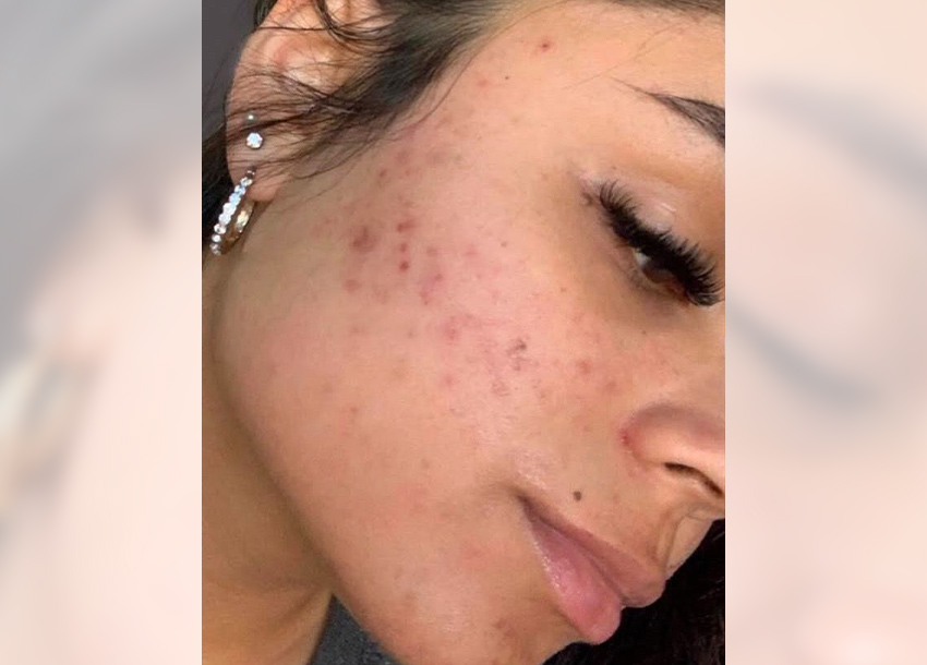 Before PRP facial treatment with Microneedling