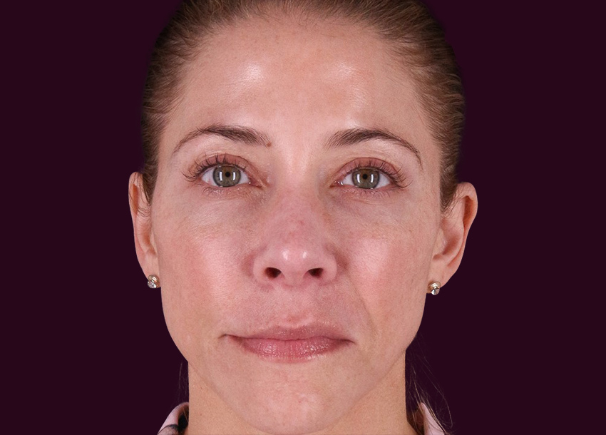 Before PRP facial treatment with Microneedling