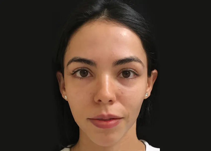 Before PRP facial treatment with Microneedling