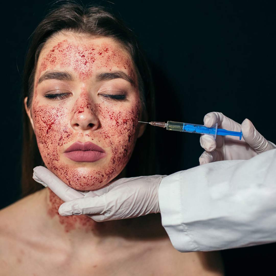 PRP with Microneedling