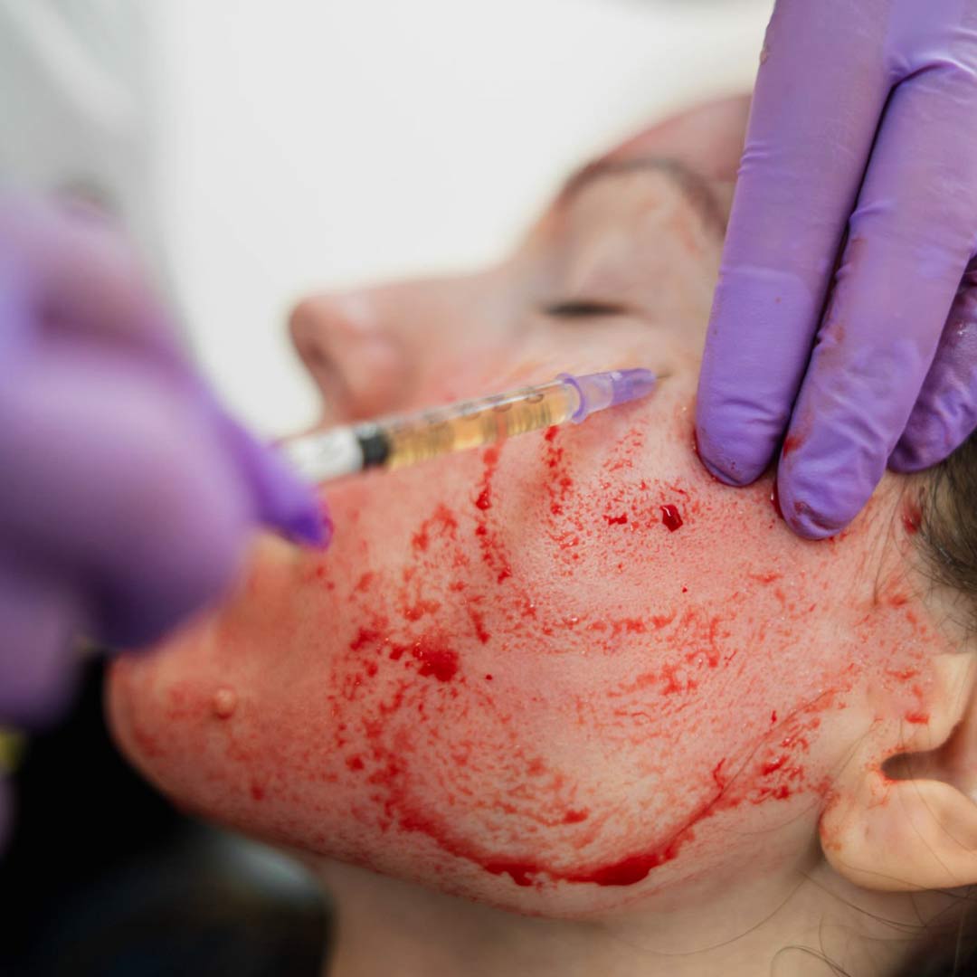 PRP with Microneedling