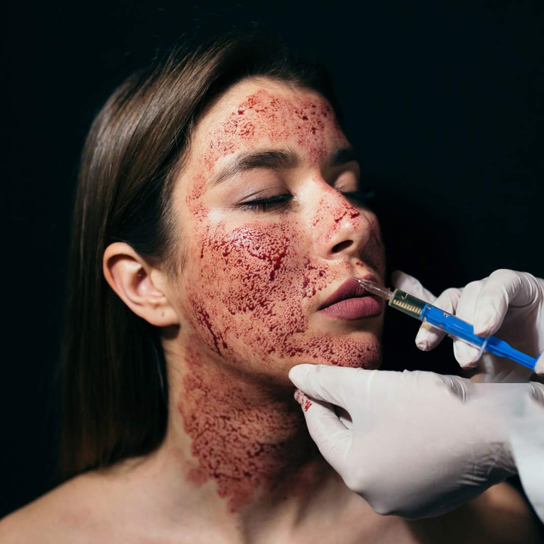PRP with Microneedling