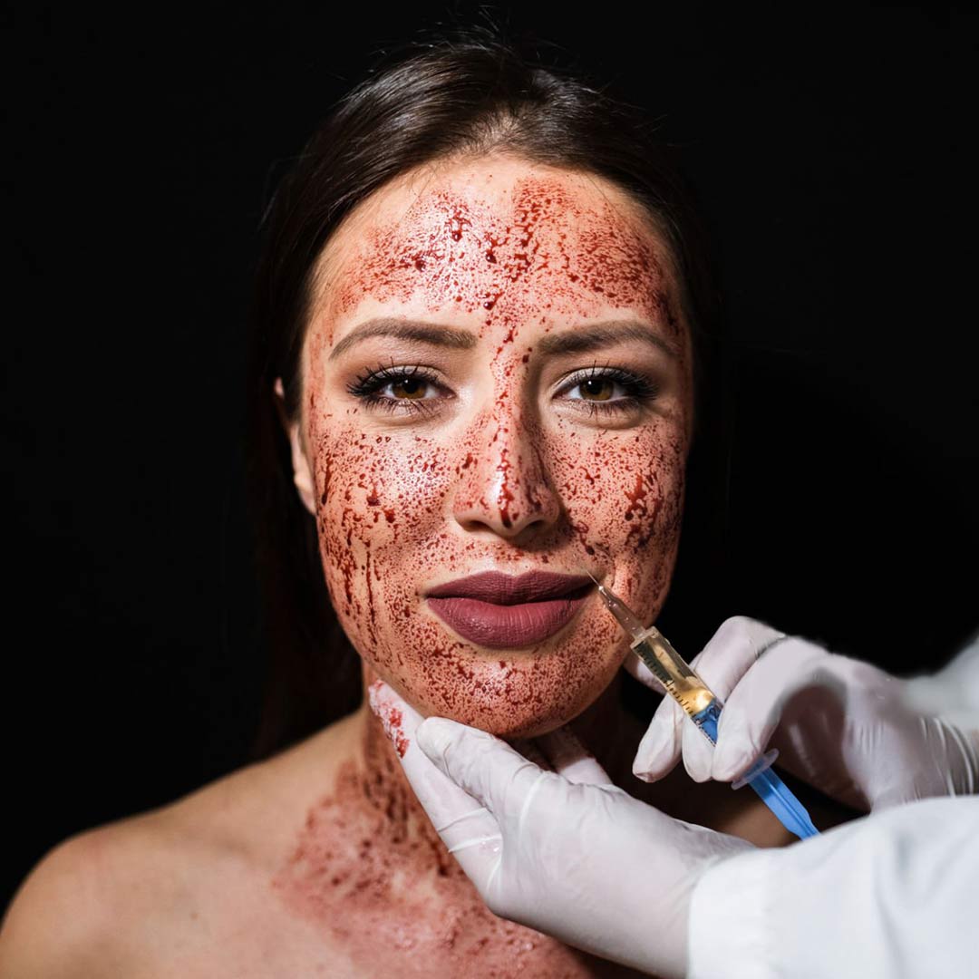 PRP with Microneedling