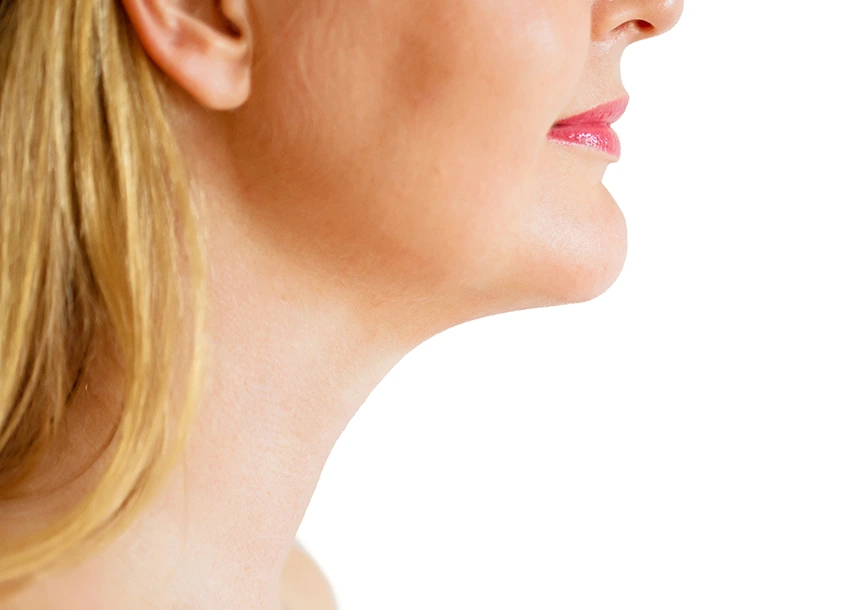 After Double Chin Removal
