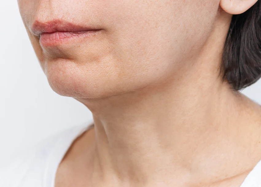 After Double Chin Removal