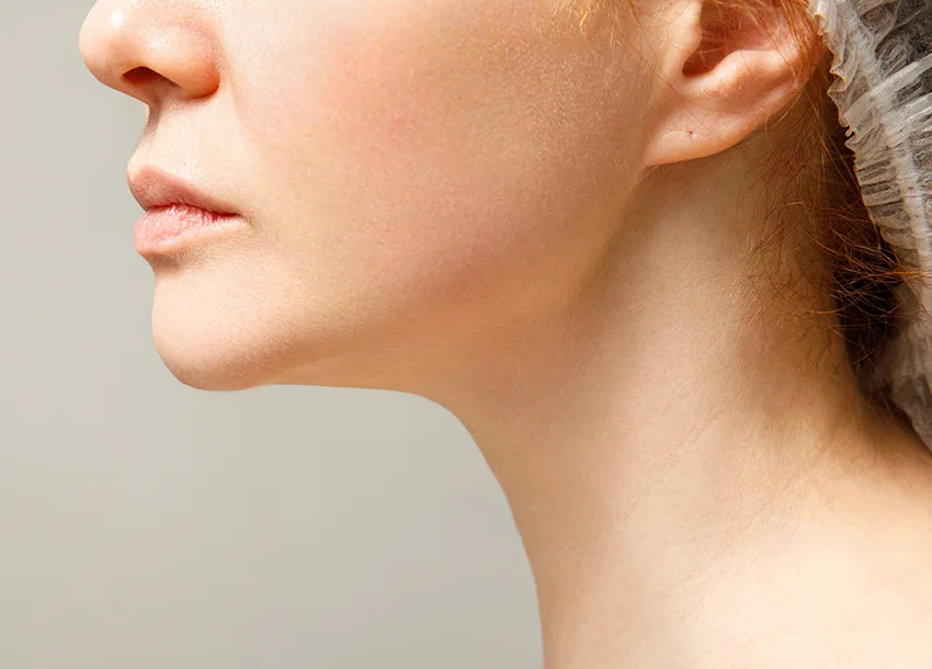 After Double Chin Removal