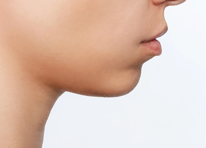 After Double Chin Removal