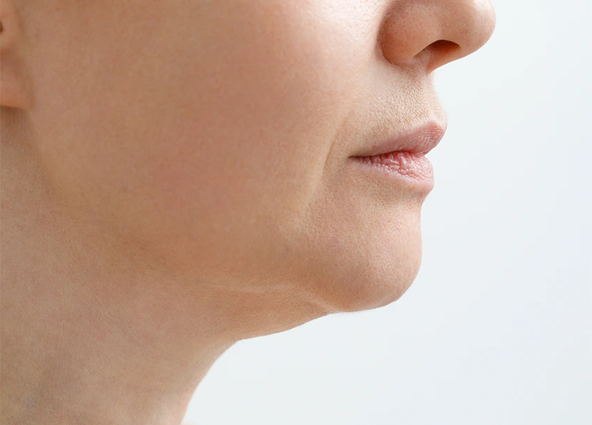 Before Double Chin Removal
