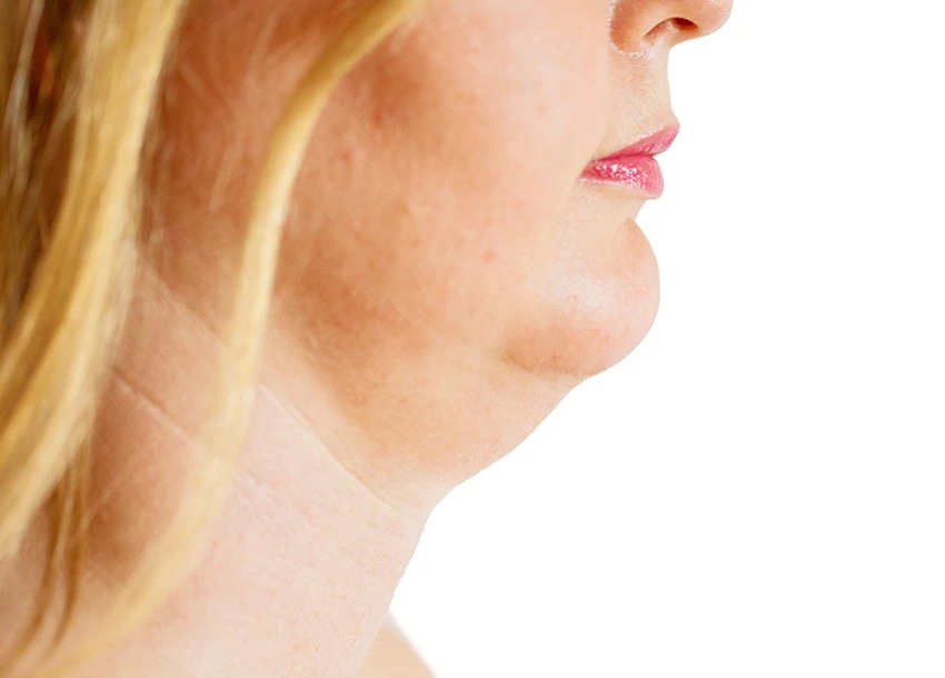 Before Double Chin Removal