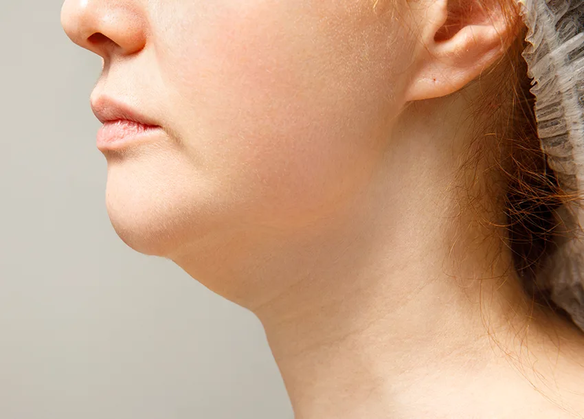 Before Double Chin Removal