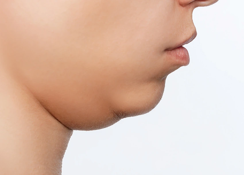 Before Double Chin Removal