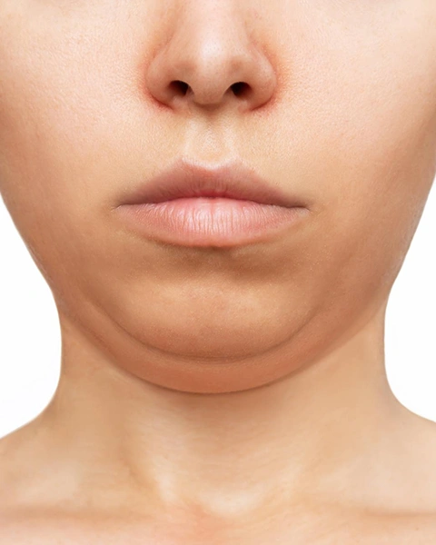 Double Chin Removal