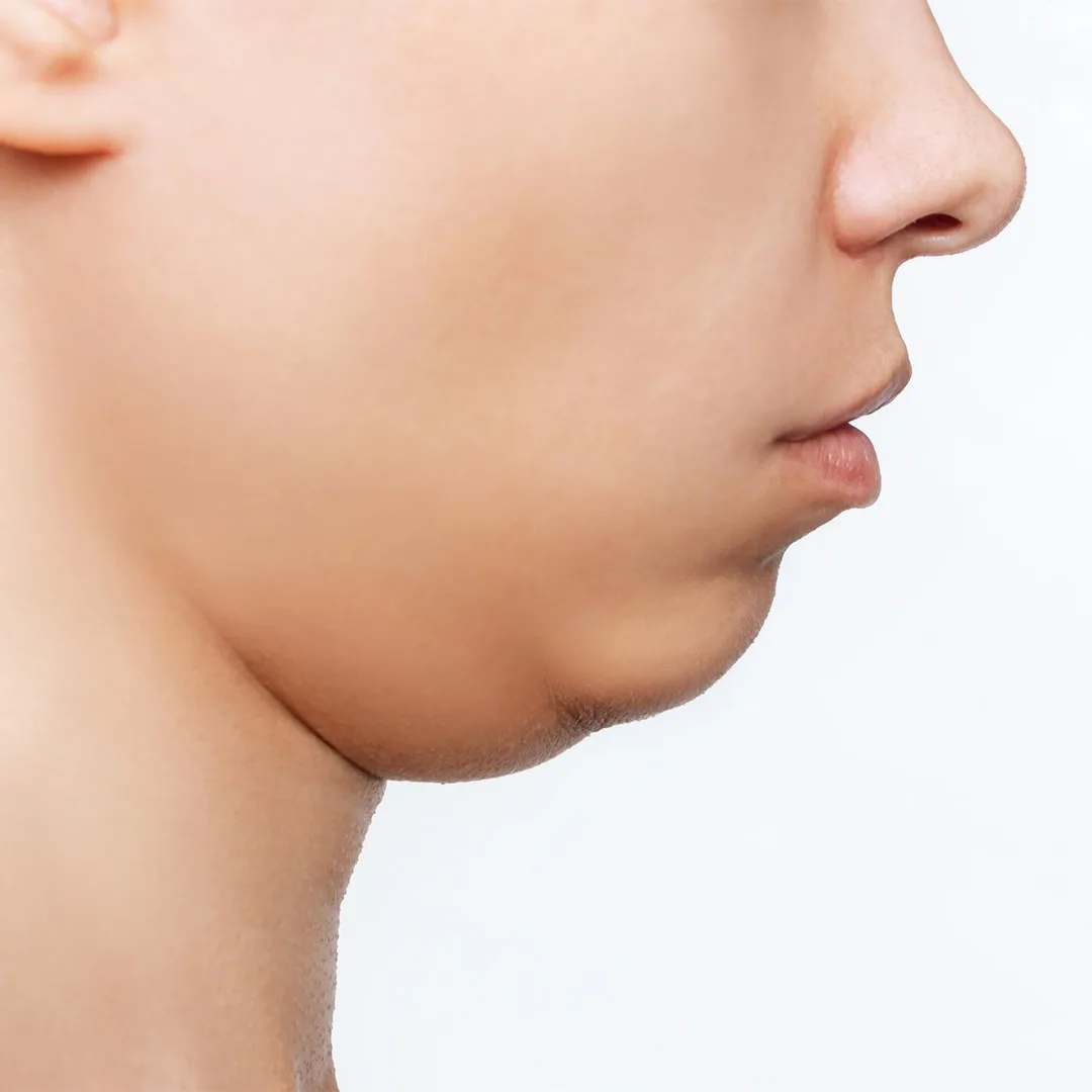 Double Chin